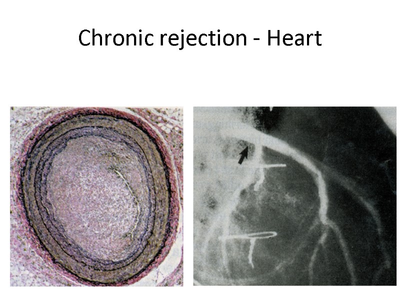 Chronic rejection - Heart